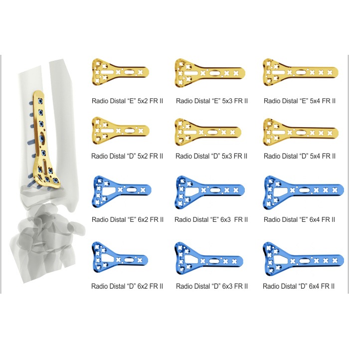 Placa Volar R Dio Distal Imagem Orth S Implantes